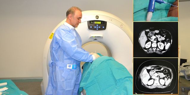 Karaciğer Kanseri Tedavisinde “Mikrodalga Ablasyon” Yöntemi