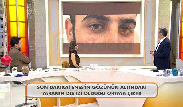 Canlı yayında Enes Güran’ın gözünün altındaki diş izine dikkat çekildi