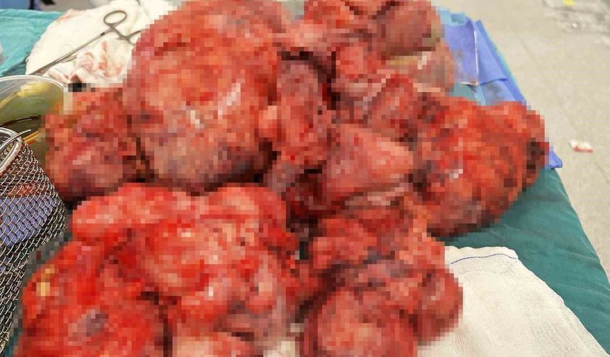 İstanbul'da başarılı operasyon: 60 santimetre çapındaki miyom rahim korunarak çıkarıldı
